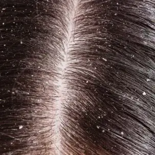 anti dandruff