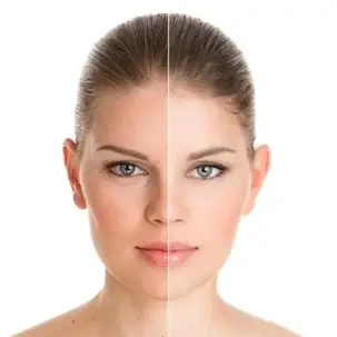 anti pigmentation